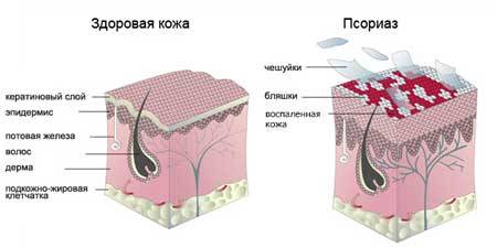 Перхоть. Симптоматика, способы диагностики и лечения, а также классификация и её причины возникновения  Перхоть. Симптоматика, способы диагностики и лечения, а также классификация и её причины возникновения